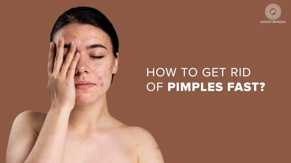 how to get rid of pimples