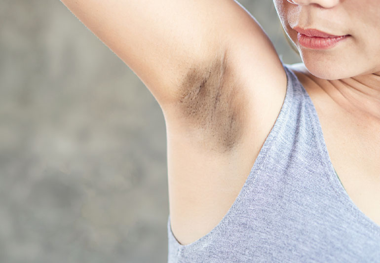 How to get rid of dark armpits naturally?